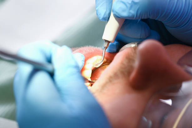 Best Dental Abscess Treatment in Medina, WA