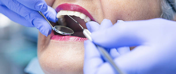Best Emergency Wisdom Tooth Extraction in Medina, WA